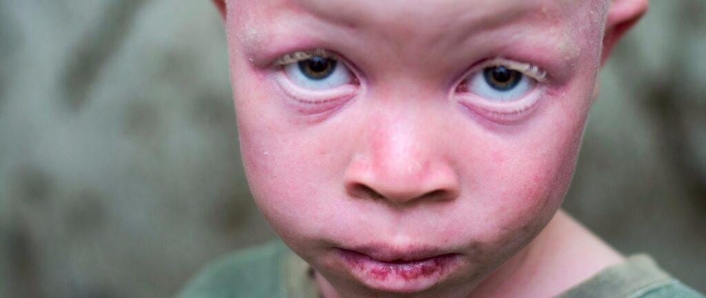 Malawi: People with albinism in urgent need of protection after horrific killing