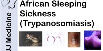East African Sleeping Sickness in Zambia and Zimbabwe – Centers for Disease Control and Prevention (.gov)