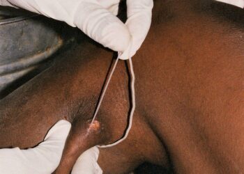 With Guinea Worm Eradication in Sight, a Celebration of a Humanitarian Legacy – unicef usa