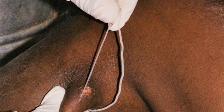 With Guinea Worm Eradication in Sight, a Celebration of a Humanitarian Legacy – unicef usa