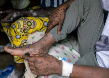 Stigma adds to Burundi’s challenges in mpox fight – Reuters