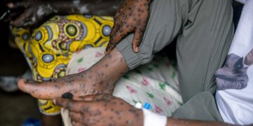Stigma adds to Burundi’s challenges in mpox fight – Reuters