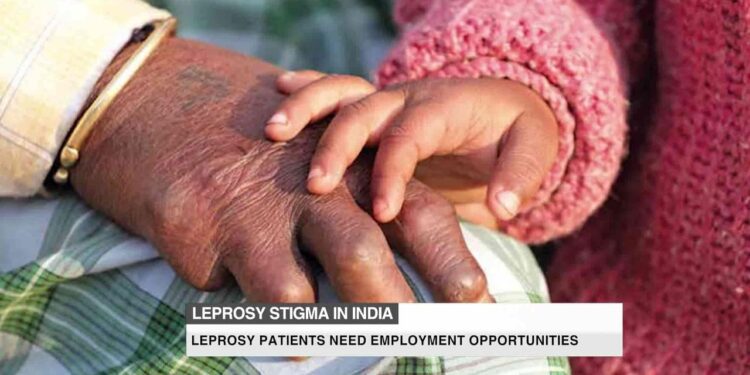 Patients with leprosy face lasting stigma in Ethiopia – WyomingNews.com