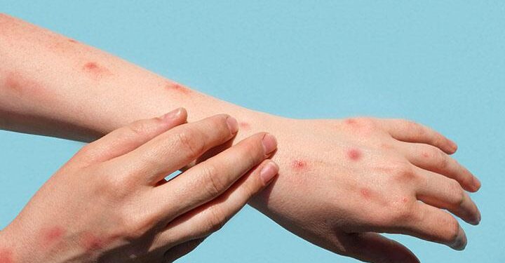 Quick takes: Mpox outbreak in Malawi, more H5N1 in Idaho and California dairy cows – CIDRAP