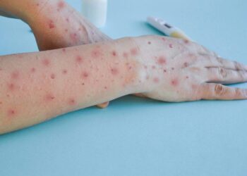 One-third of mpox cases in Burundi among school-age children – Unicef