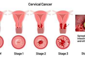 Treatable, yet deadly: Cervical cancer in Malawi – Doctors Without Borders