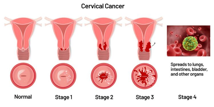 Treatable, yet deadly: Cervical cancer in Malawi – Doctors Without Borders