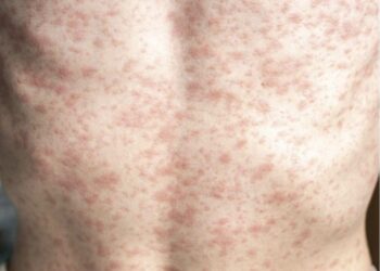 Measles cases in Europe, the Americas skyrocket – CIDRAP