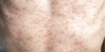 Measles cases in Europe, the Americas skyrocket – CIDRAP