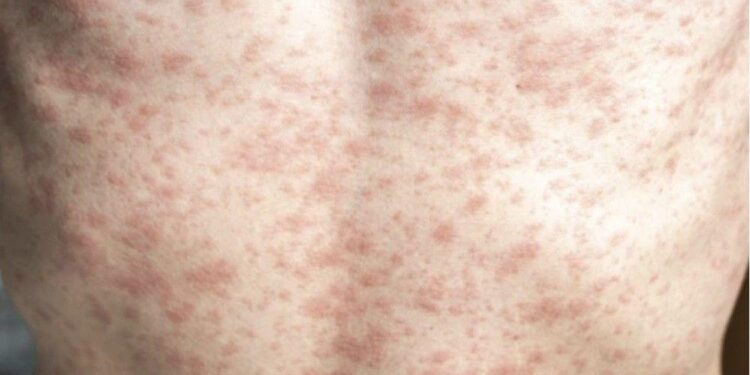 Measles cases in Europe, the Americas skyrocket – CIDRAP