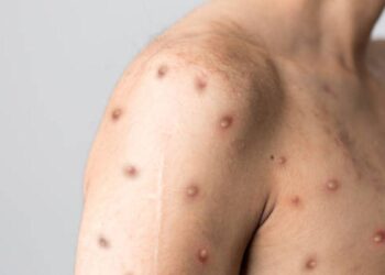 Malawi confirms sixth mpox case – The Statesman