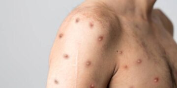 Malawi confirms sixth mpox case – The Statesman