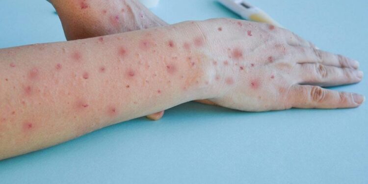 Zimbabwe reports first mpox cases – CIDRAP