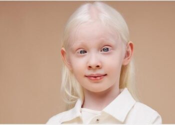 A friend killed, and inquiries shelved: life fighting the stigma of albinism in Malawi – The Guardian