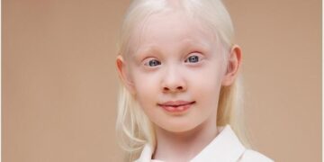 A friend killed, and inquiries shelved: life fighting the stigma of albinism in Malawi – The Guardian