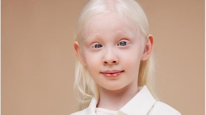 A friend killed, and inquiries shelved: life fighting the stigma of albinism in Malawi – The Guardian