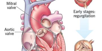 Rheumatic Heart Disease: Easing the Burden in Cape Verde – Mass General Giving