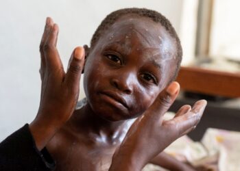 Togo reports mpox outbreak as activity escalates in West Africa – CIDRAP