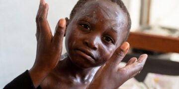 Togo reports mpox outbreak as activity escalates in West Africa – CIDRAP