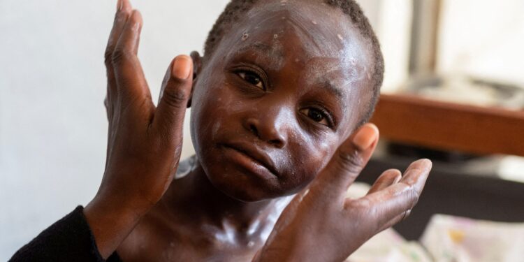 Togo reports mpox outbreak as activity escalates in West Africa – CIDRAP