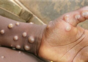 National Public Health Institute of Liberia Addresses Monkeypox Outbreak – liberianobserver.com
