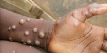National Public Health Institute of Liberia Addresses Monkeypox Outbreak – liberianobserver.com