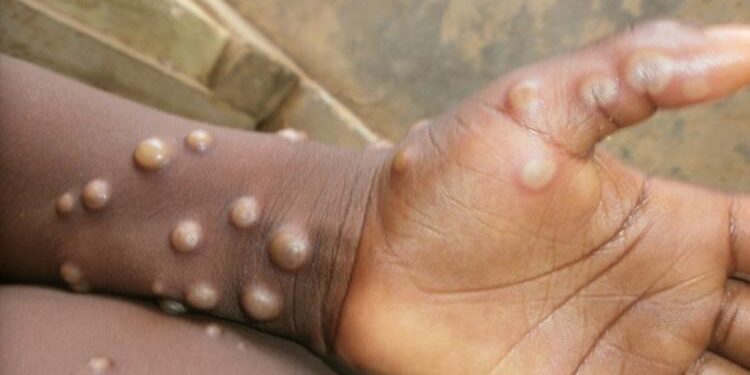 National Public Health Institute of Liberia Addresses Monkeypox Outbreak – liberianobserver.com