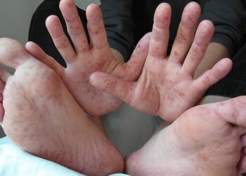 Foot-and-mouth disease contained in Hungary, farm minister says – Reuters