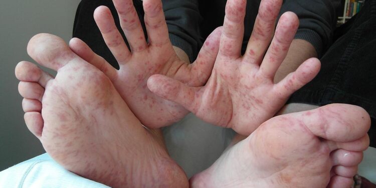 Foot-and-mouth disease contained in Hungary, farm minister says – Reuters