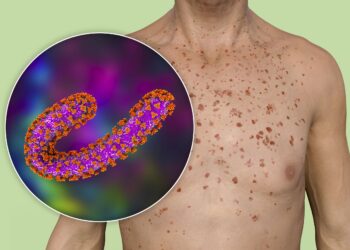 Marburg virus outbreak in Tanzania – The Lancet