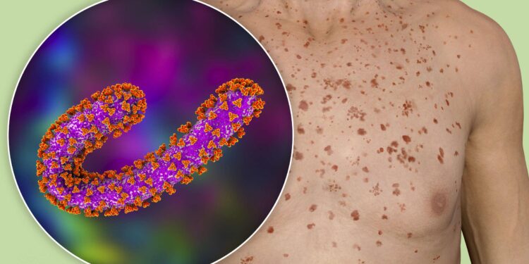 Marburg virus outbreak in Tanzania – The Lancet