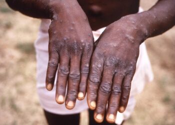 Health officials encouraged by recent trends in Africa’s mpox outbreaks – CIDRAP