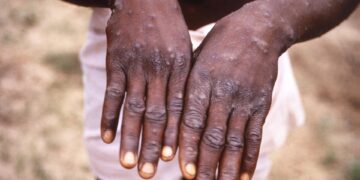 Health officials encouraged by recent trends in Africa’s mpox outbreaks – CIDRAP
