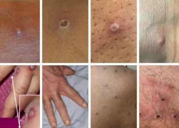 Mpox in Sierra Leone: Inside the response to a fast-moving outbreak – Nature