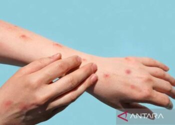 Ghana records 23 new Mpox cases, 1 death — total case count now 257 – MSN