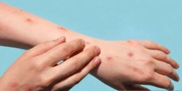 Ghana records 23 new Mpox cases, 1 death — total case count now 257 – MSN