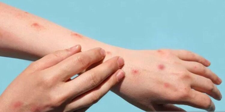 Ghana records 23 new Mpox cases, 1 death — total case count now 257 – MSN