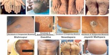 Health Alert – U.S. Embassy, Lusaka, Zambia: Acute Heavy Metal Poisoning – U.S. Embassy in Zambia (.gov)