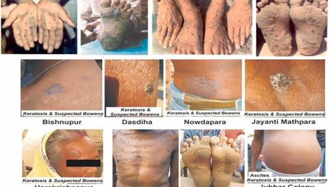 Health Alert – U.S. Embassy, Lusaka, Zambia: Acute Heavy Metal Poisoning – U.S. Embassy in Zambia (.gov)