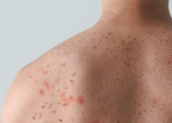 Insufficient testing allows Sierra Leone’s mpox outbreak to surge – Nature