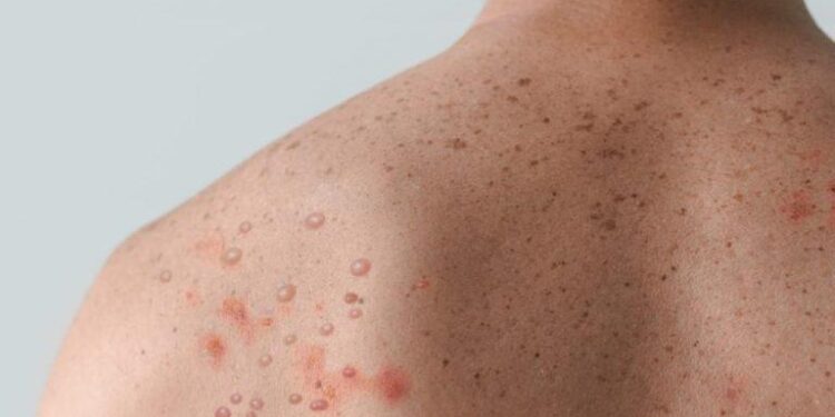 Insufficient testing allows Sierra Leone’s mpox outbreak to surge – Nature